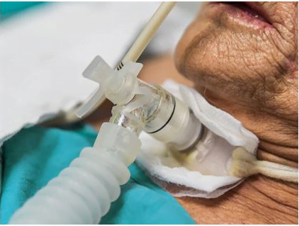 What are the different Types of Tracheostomy Tubes?