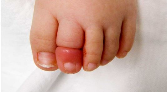 Hair wrapped around a baby’s finger