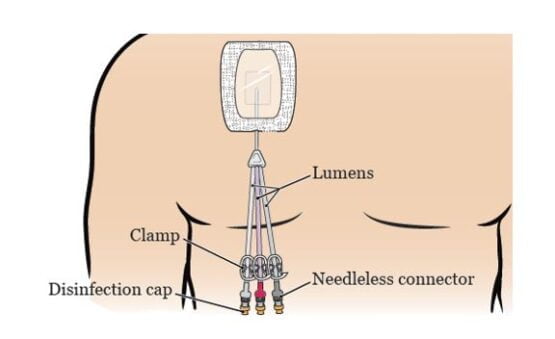A tunneled catheter set into a patient’s central vein