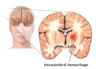 Intracerebral hemorrhage