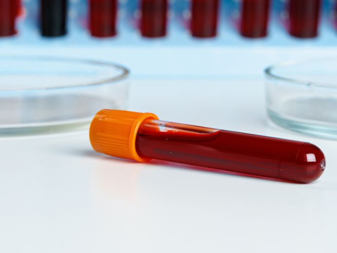 Blood sample taken from a patient to rule out or confirm the presence of infectious mononucleosis