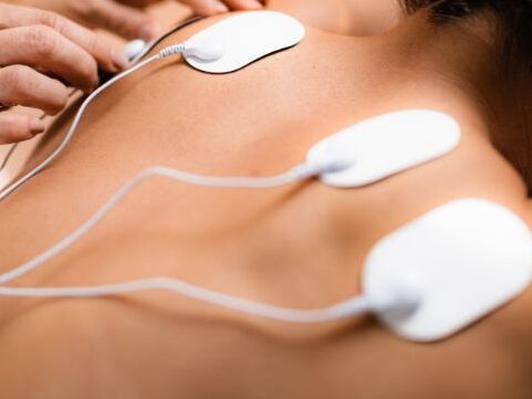 A TENS unit system being used in a patient for the management of muscle pain A TENS unit system being used in a patient for the management of muscle pain