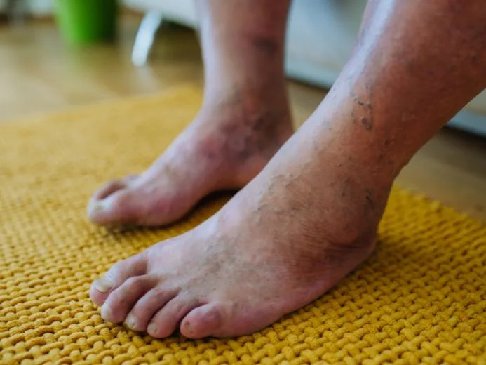 diabetic foot infection