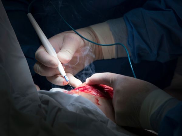 The ConMed Hyfrecator 2000 in use during a precise electrosurgical procedure, demonstrating its efficacy in tissue cauterization and lesion removal