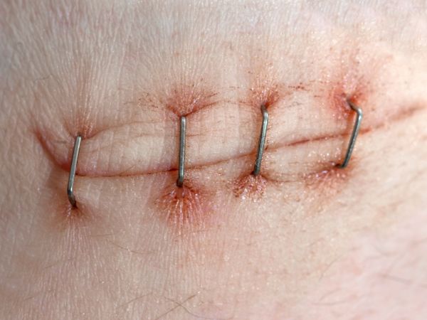 Surgical staples are holding the skin together to heal the wound Surgical staples are holding the skin together to heal the wound