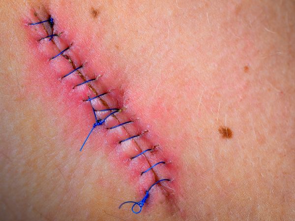 Suture thread has been used to apply stitches on the open wound Suture thread has been used to apply stitches on the open wound