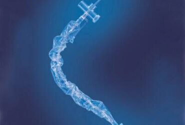 SUN MED Closed Suction Catheter 21513511 - Kimvent Tracheostomy 12 Fr 