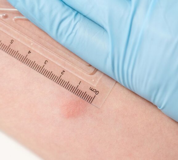 A smaller induration size indicates a negative test result