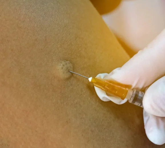 Formation of bled when Aplisol injection is given indicates correct administration