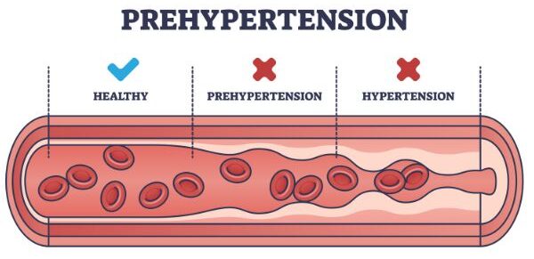 Postural orthostatic tachycardia syndrome happens due to the shrinkage of blood vessels during standing up