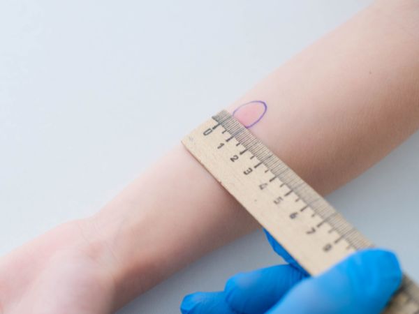 The size of the induration after Aplisol injection determines a positive or a negative test