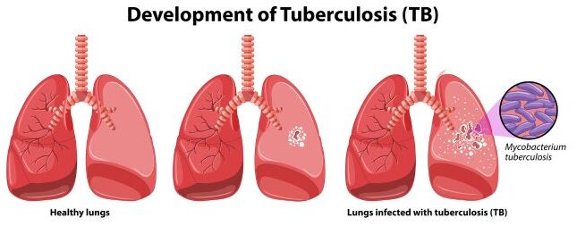 Untreated tuberculosis leads to death in almost 50% of the cases Untreated tuberculosis leads to death in almost 50% of the cases